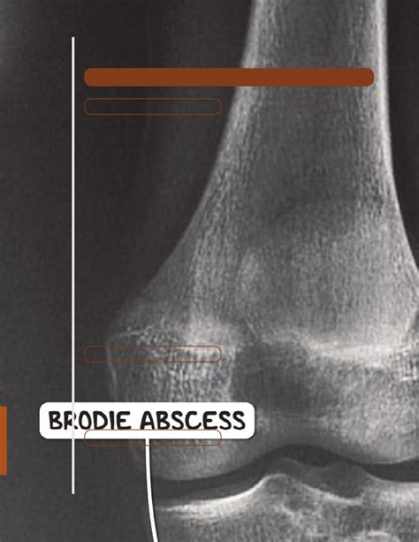 Osteomyelitis Osmosis