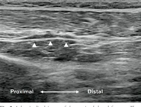 Figure 2 From Palsy Of The Posterior Interosseous Nerve Treated By Targeted Ultrasound Guided