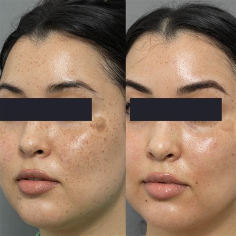 Pico Laser Pigment Freckles Cutis Dermatology