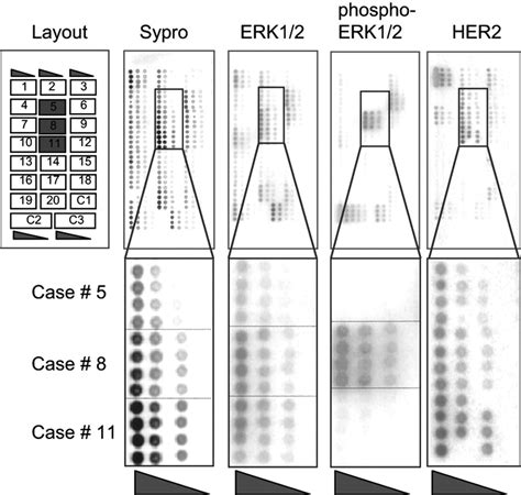 Protein microarray analysis from extracts of 20 breast cancer samples ...