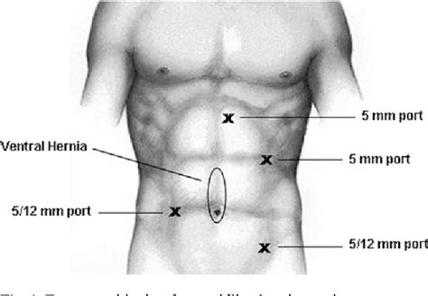 A Prof Jaber Incisional And Ventral Hernia Repair | Hot Sex Picture