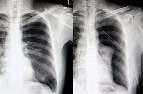 Pneumothorax TeachMeSurgery