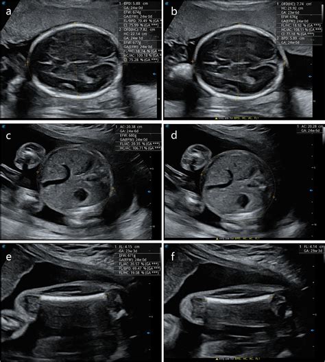 A Prenatal Ultrasound Scanning Approach One Touch Technique In Second