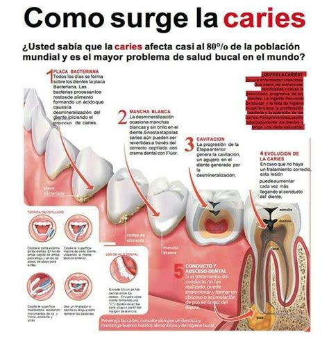 Caries Escuela De Higiene Dental Caries Dental Cuidado Dental