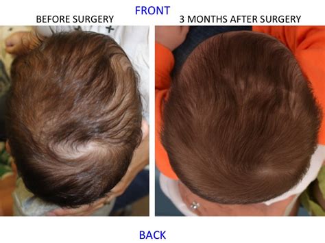 Minimally Invasive Endoscopic Sagittal Strip Craniectomy Dallas