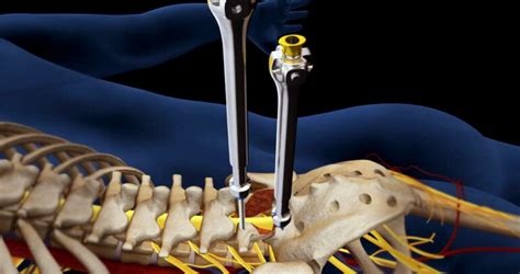 L5-S1 Herniated Disc Surgery - Discseel