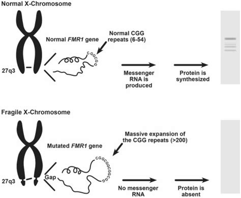 Fragile X Syndrome The Journal Of Molecular Diagnostics