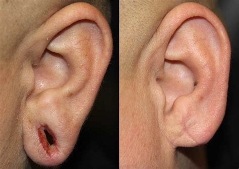 Otoplasty Earlobe Repair Daines Plastic Surgery