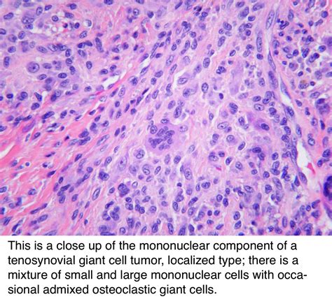 Pathology Outlines Tenosynovial Giant Cell Tumor Localized Type