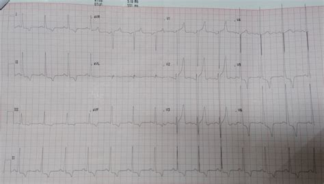 cardiology window left ventricular hypertrophy  lv strain pattern