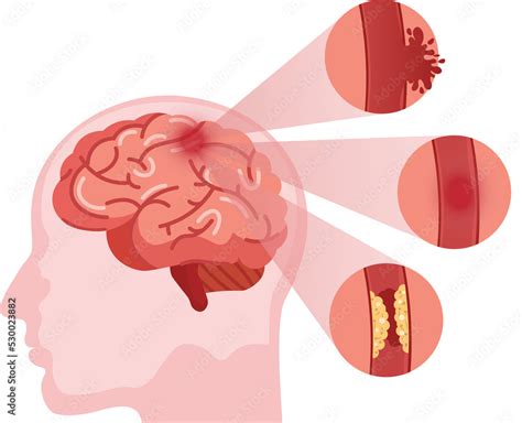 Stroke Disease Hemorrhagic Brain Stroke Concept Apoplexy Cerebral Hemorrhage Headache