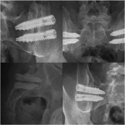 Posterior Oblique Fusion Of The Sacroiliac Joint Series Of Images