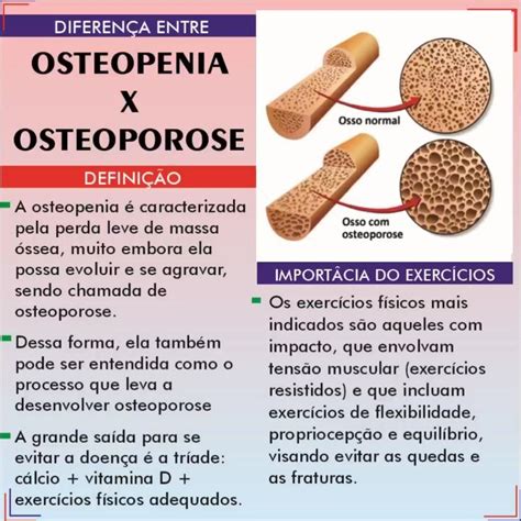 Diferen A Entre Osteopenia X Osteoporose Posts