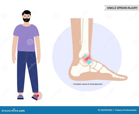 Sprained Ankle Injury Vector Illustration Cartoondealer