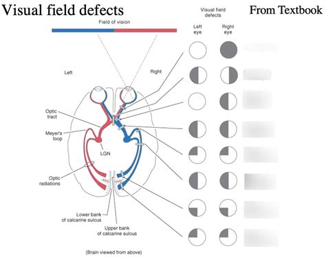 Naming Visual Field Defects Diagram | Quizlet