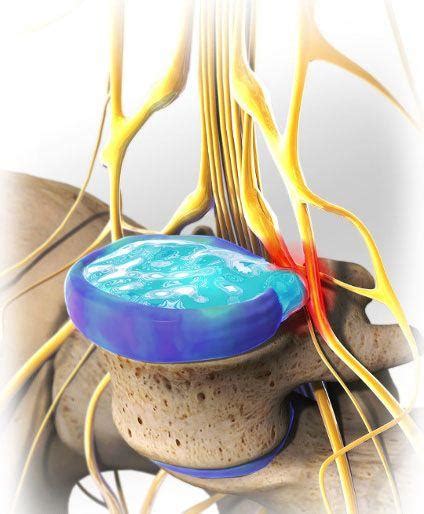 腰椎間盤突出什麼方法好？認識腰椎間盤、椎間孔與神經根的關係！ 每日頭條