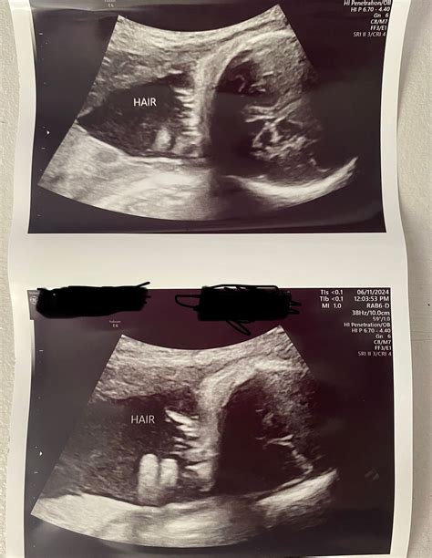 Hair on ultrasound? | BabyCenter