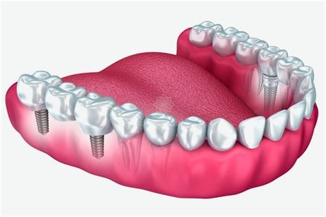 Protesis Parcial Removible Cl Nica Dental M Laga