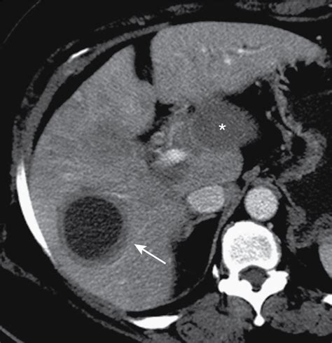 Benign focal liver lesions | Radiology Key