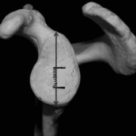 Length of the glenoid cavity measurement. | Download Scientific Diagram