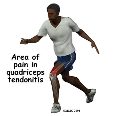 Quadriceps Tendonitis Treatment | Symptoms | Alleviate Pain Clinic