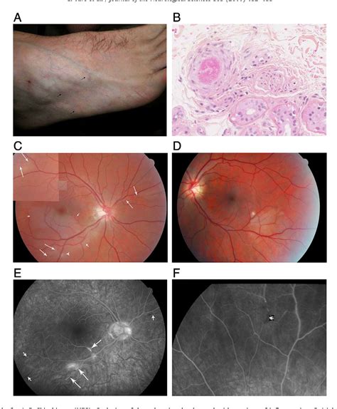 Figure From Skin Involvement In Susac S Syndrome Semantic Scholar