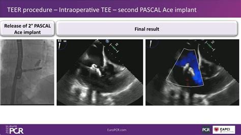 Tailoring Tricuspid Regurgitation Patient Treatment With The Pascal