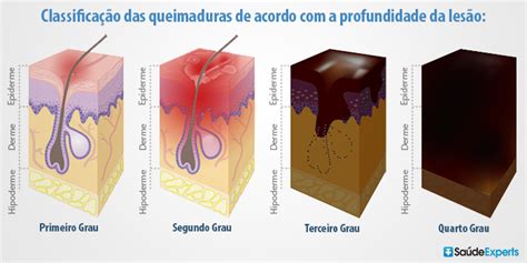 Tipos De Queimaduras Na Pele - Classificação De Queimaduras : 1°, 2° e 3° graus: conheça os tipos de ...