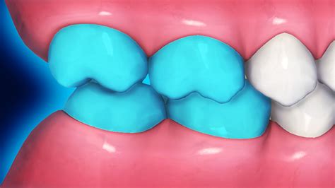 3 Molar Movements For More Effective Class Ii Correction With Clear Aligners Invisalign