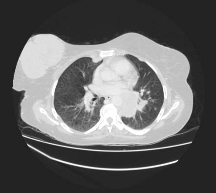 Breast Metastases From Facial Malignant Melanoma Image Radiopaedia Org