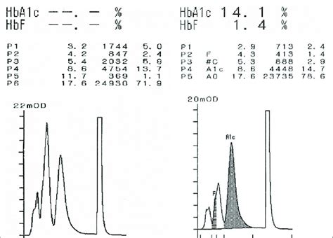 A Chromatogram With Abnormal Peak Fractions Observed In The HPLC