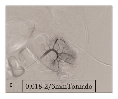 A Selective Renal Arteriogram Shows A Pa Arise From The Left Download Scientific Diagram