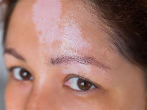 Ruxolitinib Cream Results In Greater Repigmentation In Vitiligo