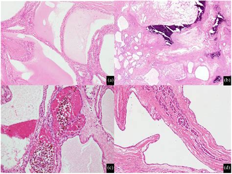 Serous Cystadenoma Of Pancreas A Clinicopathologic Experience Of