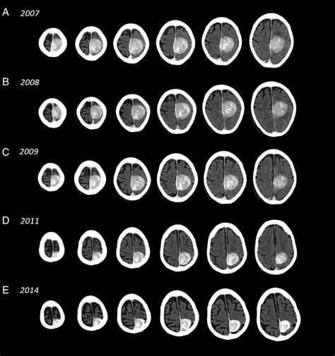 Size Of Meningioma Tumor Hot Sex Picture