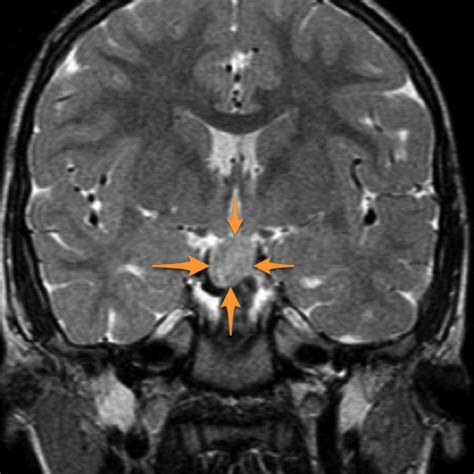 Hypothalamic Hamartoma Image Radiopaedia Org