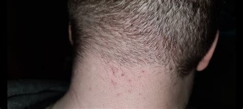 Folliculitis On Neck For 4 Years Rfolliculitis