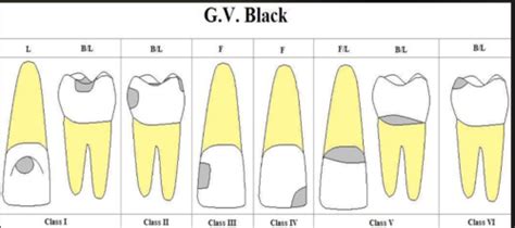 Radiographic Interpretation Of Dental Caries Flashcards Quizlet