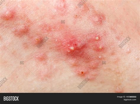 Nodular Cystic Acne Image & Photo (Free Trial) | Bigstock