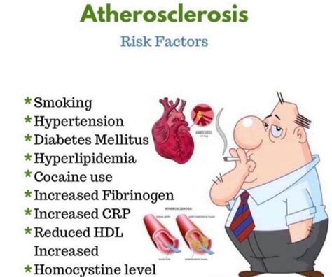 Atherosclerosis Risk Factors Medizzy