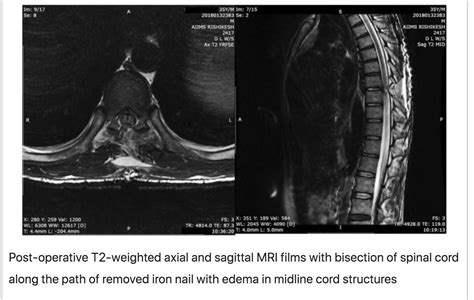 Oren Gottfried Md On Twitter Postop Evidence Of Bisected Cord