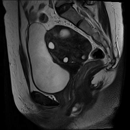 Ovarian Torsion Radiology Case Radiopaedia Org