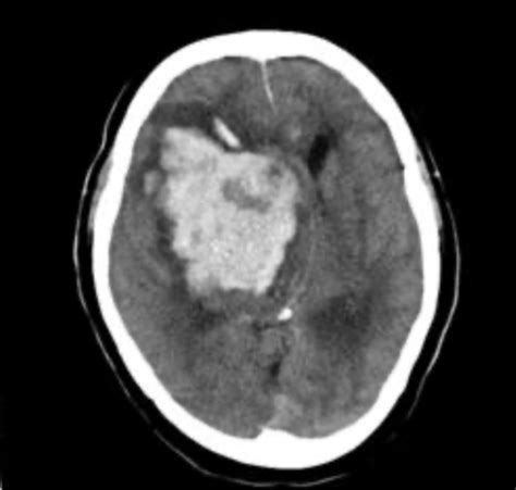 Imaging Of Acute Strokes Guided Study Flashcards Quizlet