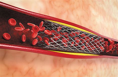 Blood thinners after a stent: How long? - Harvard Health