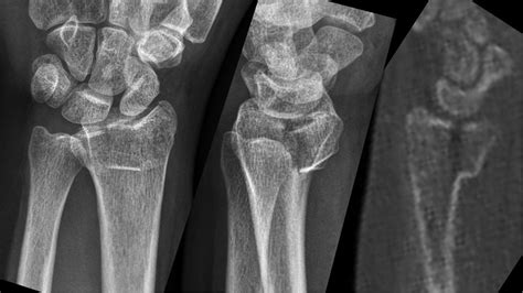 Biomechanics Of Distal Radius Fractures Clinical Tree