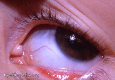 congenital anomaly of caruncula lacrimalis. EyeRounds.org: Online ...