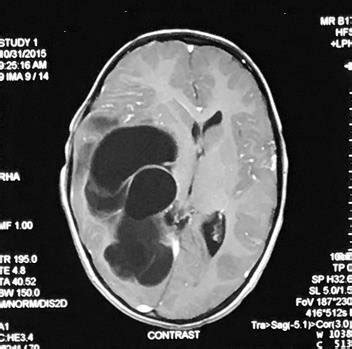 Mri Brain T Weighted Post Contrast Image Mild Peripheral Enhancement