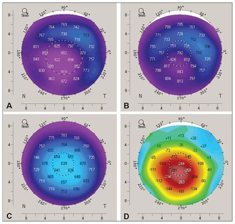 Bilateral Corneal Edema Associated With Amantadine Cmaj