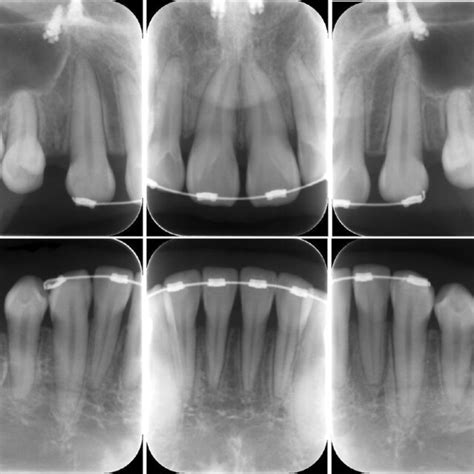 Intraoral Periapical Radiographs After Periodontal Treatment No