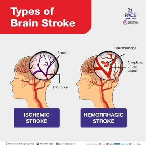 Stroke Symptoms Artofit